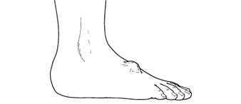 Ganglion Cyst - Columbus Foot and Ankle