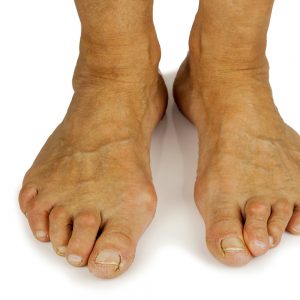 Hammertoe - Columbus Foot and Ankle